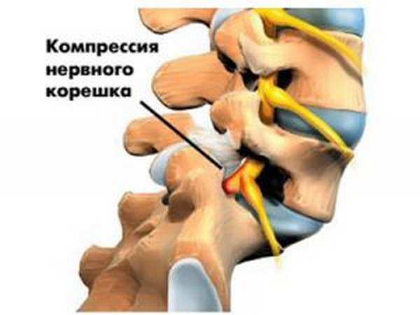 Причины и лечение невралгии при остеохондрозе